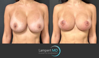 Breast Revision Before & After Gallery - Patient 122908894 - Image 1