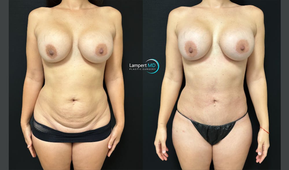 Tummy Tuck Before & After Gallery - Patient 122909208 - Image 1