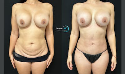 Tummy Tuck Before & After Gallery - Patient 122909208 - Image 1