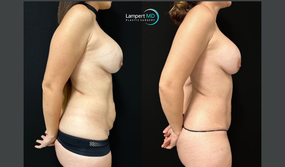 Tummy Tuck Before & After Gallery - Patient 122909208 - Image 4