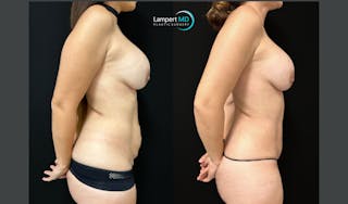 Tummy Tuck Before & After Gallery - Patient 122909208 - Image 4