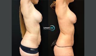 Tummy Tuck Before & After Gallery - Patient 122909208 - Image 5