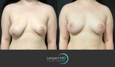 Breast Lift Before & After Gallery - Patient 166431 - Image 1