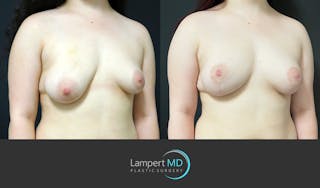 Breast Reconstruction Before & After Gallery - Patient 284384 - Image 2