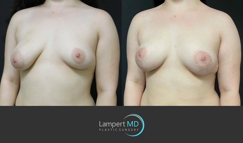 Breast Reconstruction Before & After Gallery - Patient 284384 - Image 3