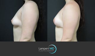 Breast Reconstruction Before & After Gallery - Patient 284384 - Image 4