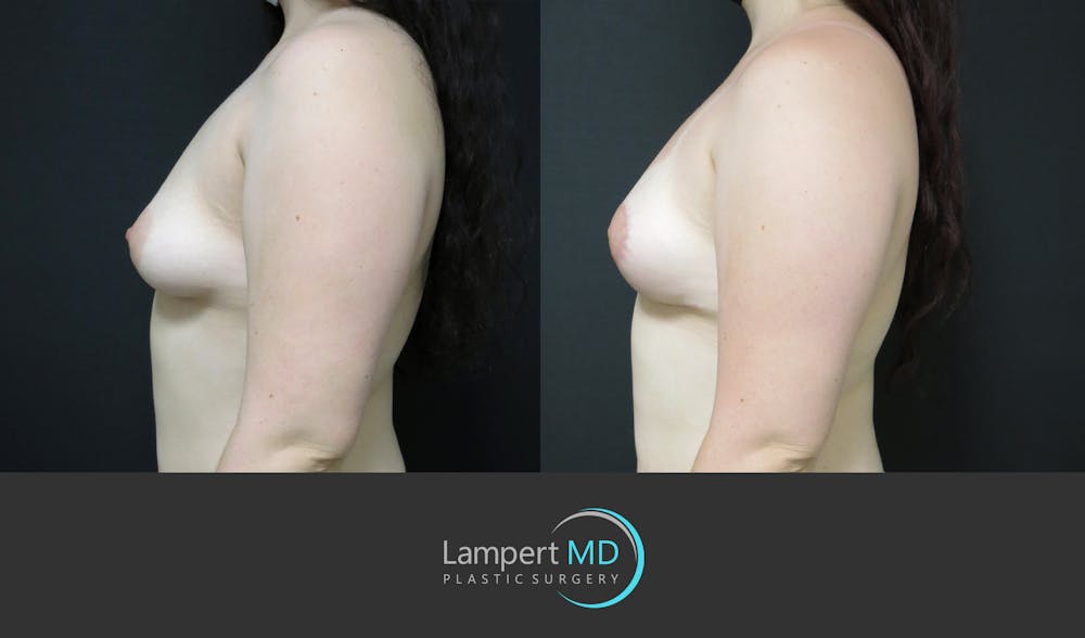 Breast Lift Before & After Gallery - Patient 166431 - Image 4