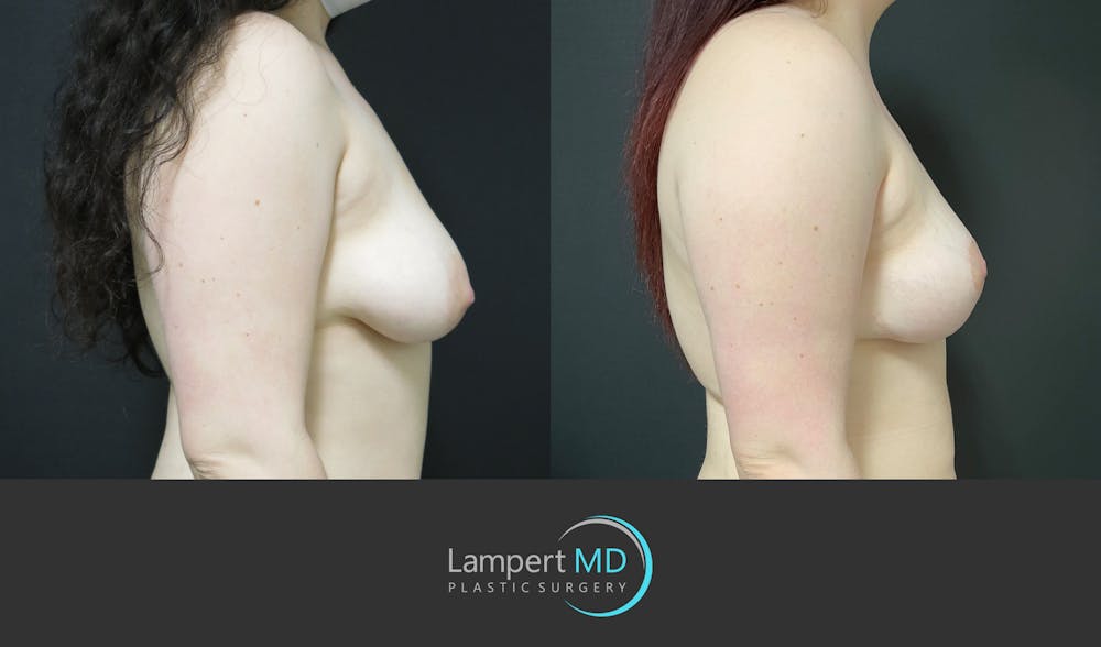 Breast Lift Before & After Gallery - Patient 166431 - Image 5