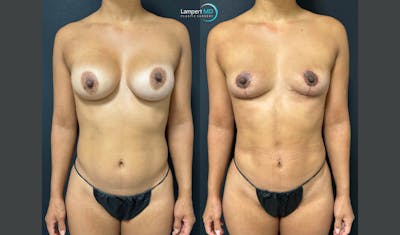 Breast Explant Before & After Gallery - Patient 387671 - Image 1