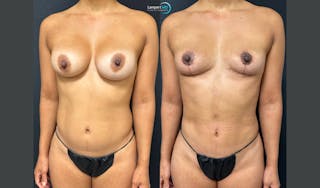 Breast Explant Before & After Gallery - Patient 387671 - Image 2