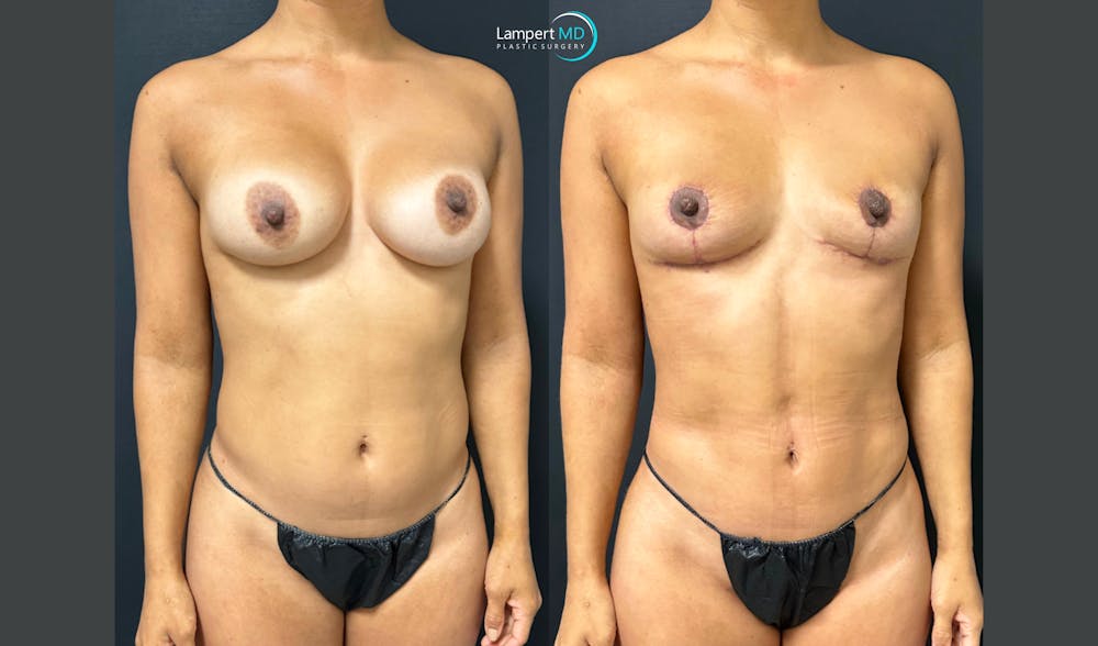 Breast Explant Before & After Gallery - Patient 387671 - Image 3