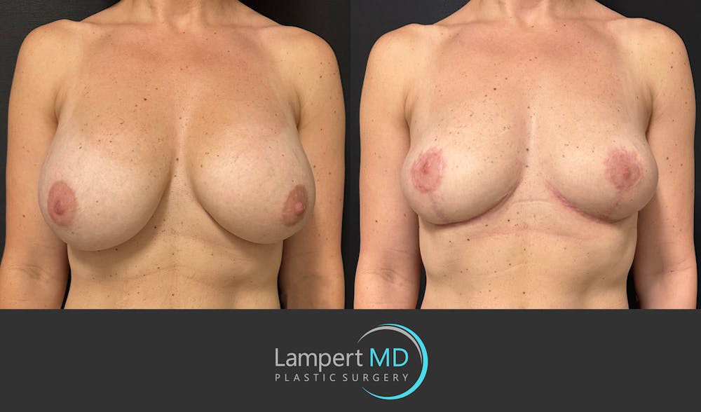 Breast Explant Before & After Gallery - Patient 184651654 - Image 1
