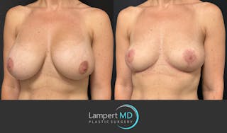Breast Explant Before & After Gallery - Patient 184651654 - Image 2