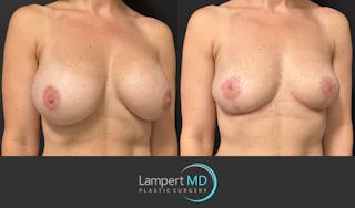 Breast Explant Before & After Gallery - Patient 184651654 - Image 3