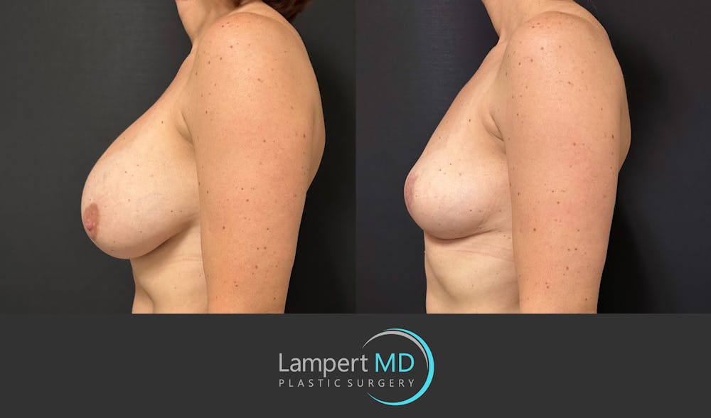 Breast Explant Before & After Gallery - Patient 184651654 - Image 4