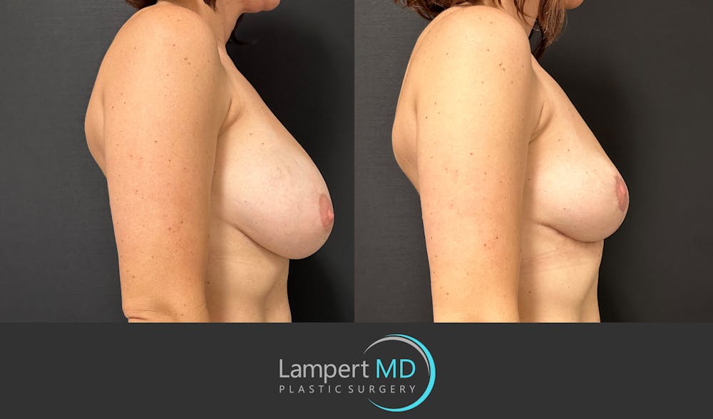 Breast Explant Before & After Gallery - Patient 184651654 - Image 5