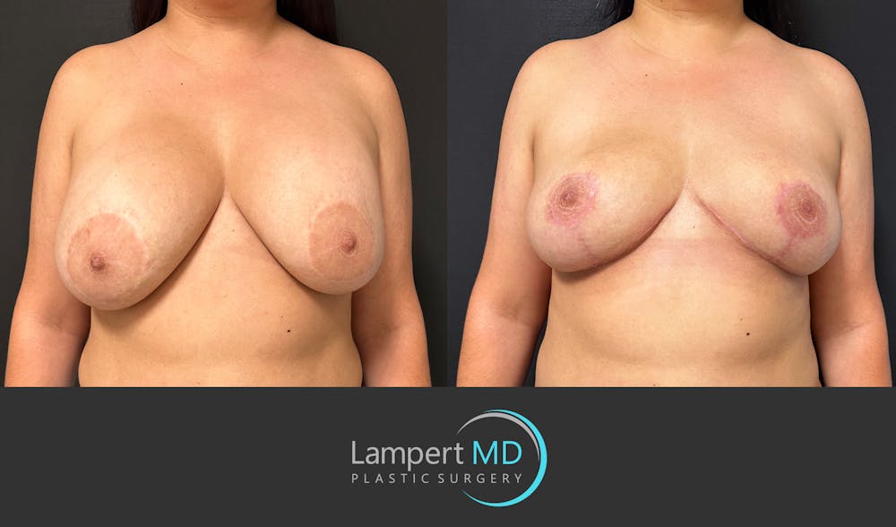 Breast Explant Before & After Gallery - Patient 325996 - Image 1