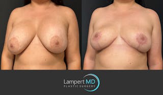 Breast Explant Before & After Gallery - Patient 325996 - Image 2