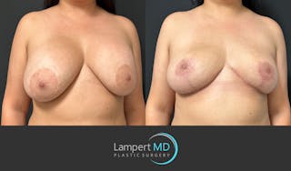 Breast Explant Before & After Gallery - Patient 325996 - Image 3