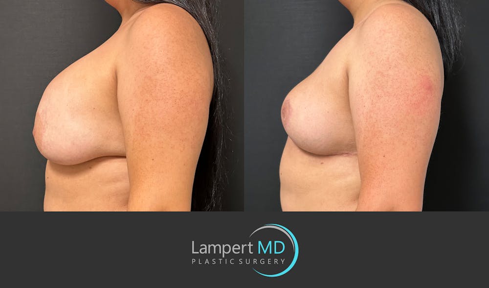 Breast Explant Before & After Gallery - Patient 325996 - Image 4