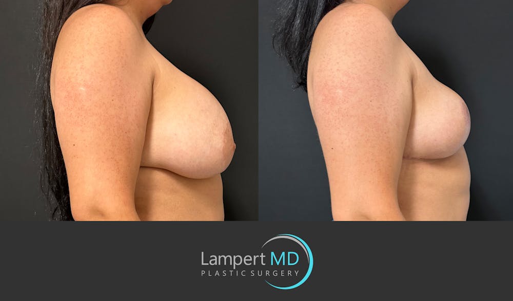 Breast Explant Before & After Gallery - Patient 325996 - Image 5