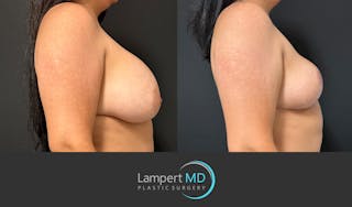 Breast Explant Before & After Gallery - Patient 325996 - Image 5