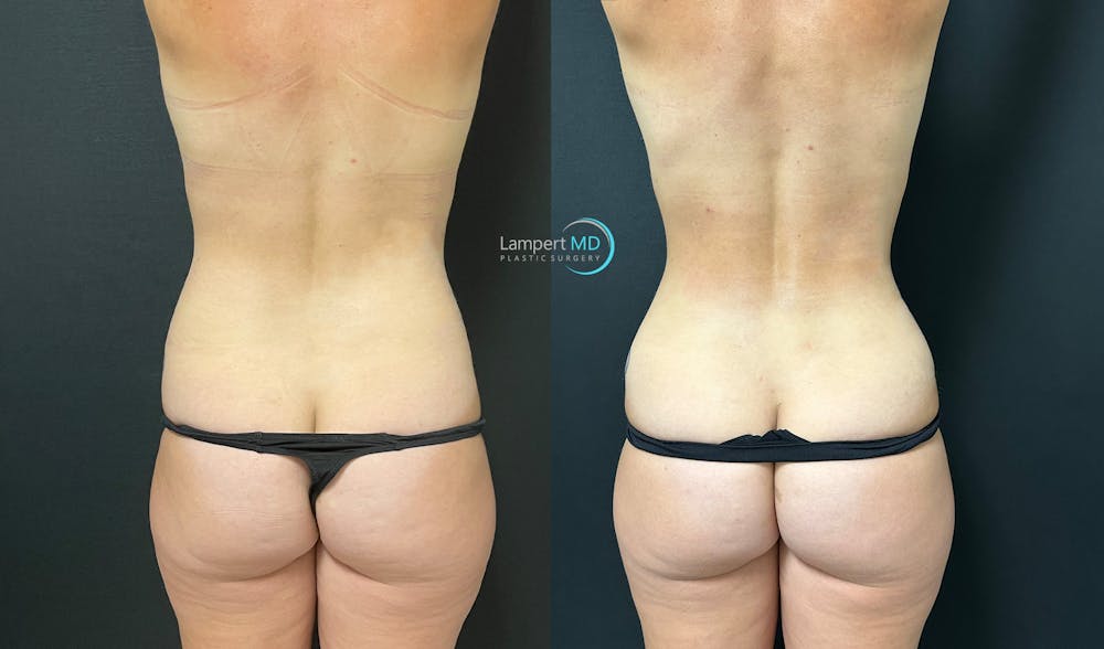 Love Handle Liposuction Before & After Gallery - Patient 292684 - Image 1