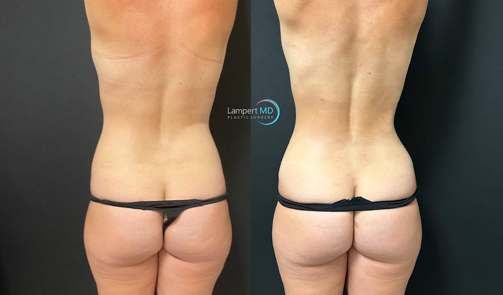 Love Handle Liposuction Before & After Gallery - Patient 292684 - Image 3