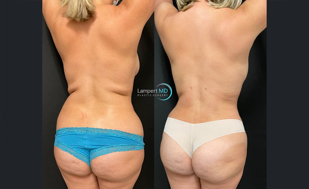 Love Handle Liposuction Before & After Gallery - Patient 284091 - Image 2