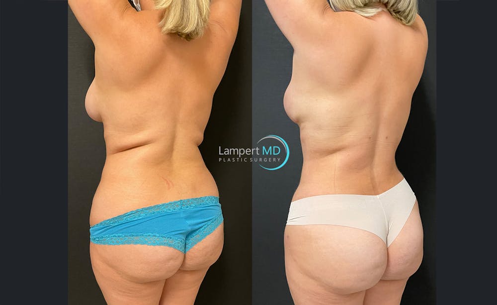 Love Handle Liposuction Before & After Gallery - Patient 284091 - Image 3