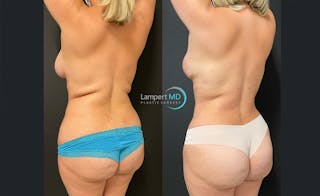 Love Handle Liposuction Before & After Gallery - Patient 284091 - Image 3