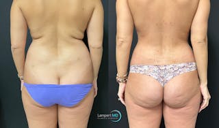 Love Handle Liposuction Before & After Gallery - Patient 411723 - Image 1