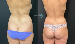 Love Handle Liposuction Before & After Gallery - Patient 411723 - Image 2