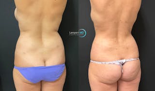 Love Handle Liposuction Before & After Gallery - Patient 411723 - Image 3