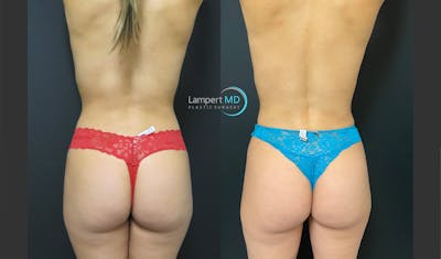 Love Handle Liposuction Before & After Gallery - Patient 102845 - Image 1