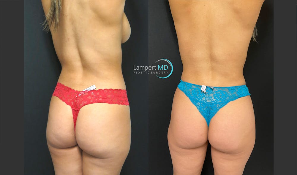 Love Handle Liposuction Before & After Gallery - Patient 102845 - Image 3