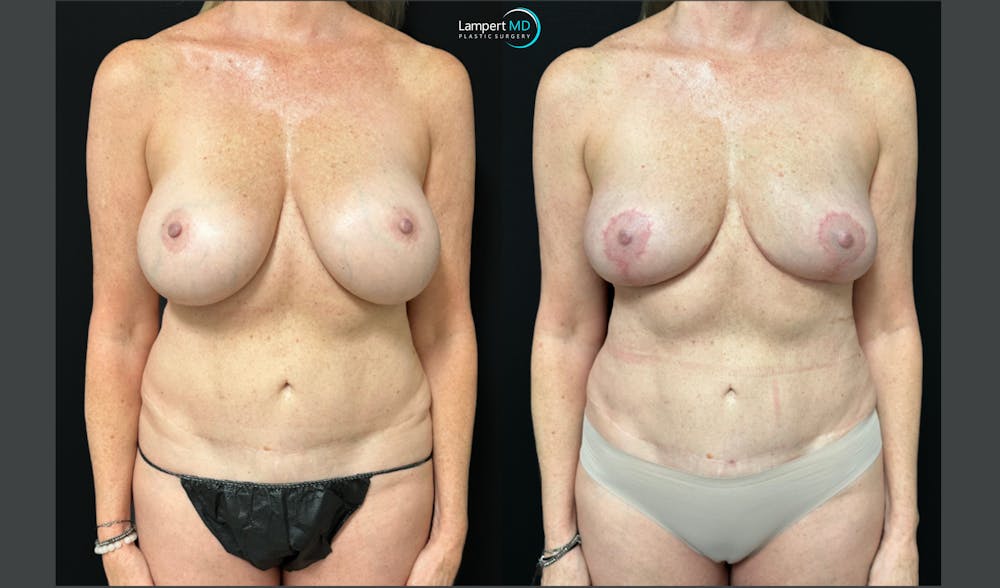 Breast Explant Before & After Gallery - Patient 293831 - Image 1