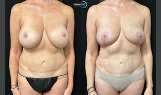 Breast Explant Before & After Gallery - Patient 293831 - Image 2