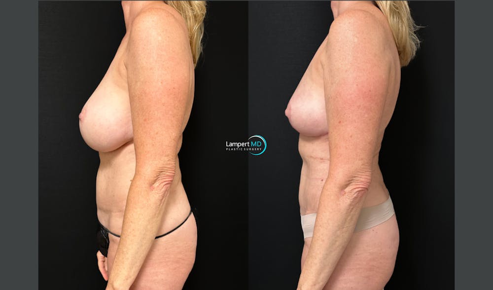 Breast Explant Before & After Gallery - Patient 293831 - Image 3