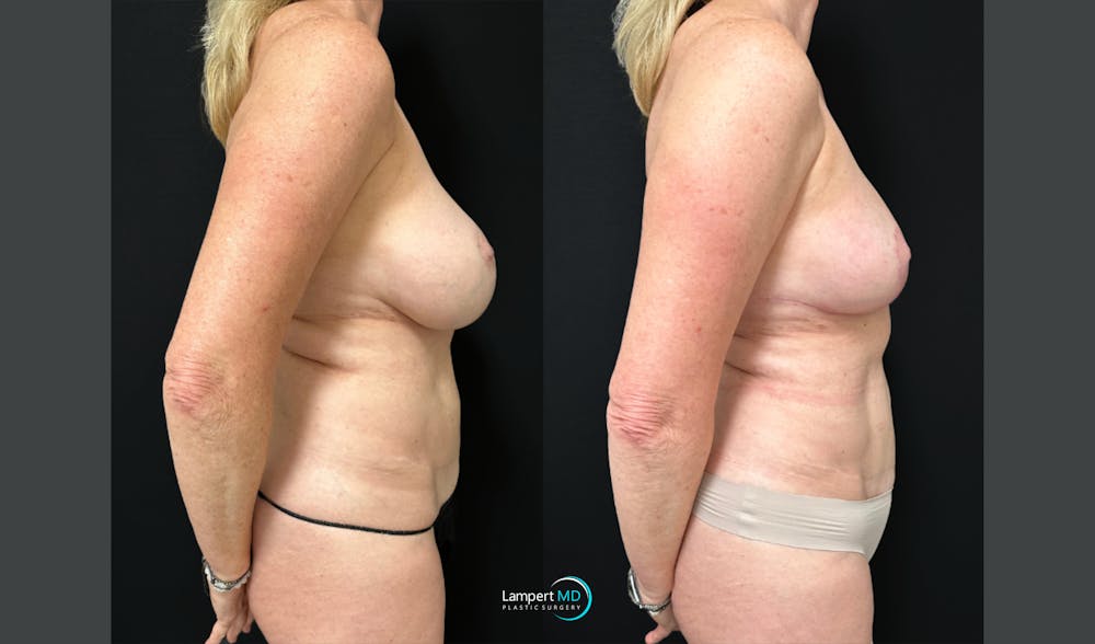 Breast Explant Before & After Gallery - Patient 293831 - Image 4