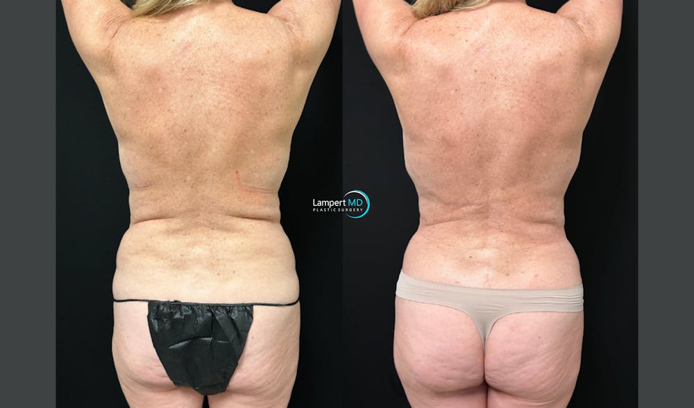 Breast Explant Before & After Gallery - Patient 293831 - Image 6