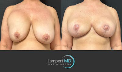 Breast Explant Before & After Gallery - Patient 428677 - Image 1