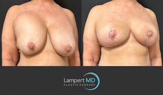 Breast Explant Before & After Gallery - Patient 428677 - Image 2