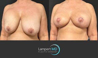 Breast Explant Before & After Gallery - Patient 428677 - Image 3