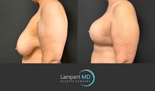 Breast Explant Before & After Gallery - Patient 428677 - Image 4