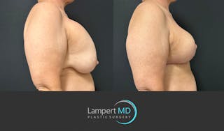 Breast Explant Before & After Gallery - Patient 428677 - Image 5