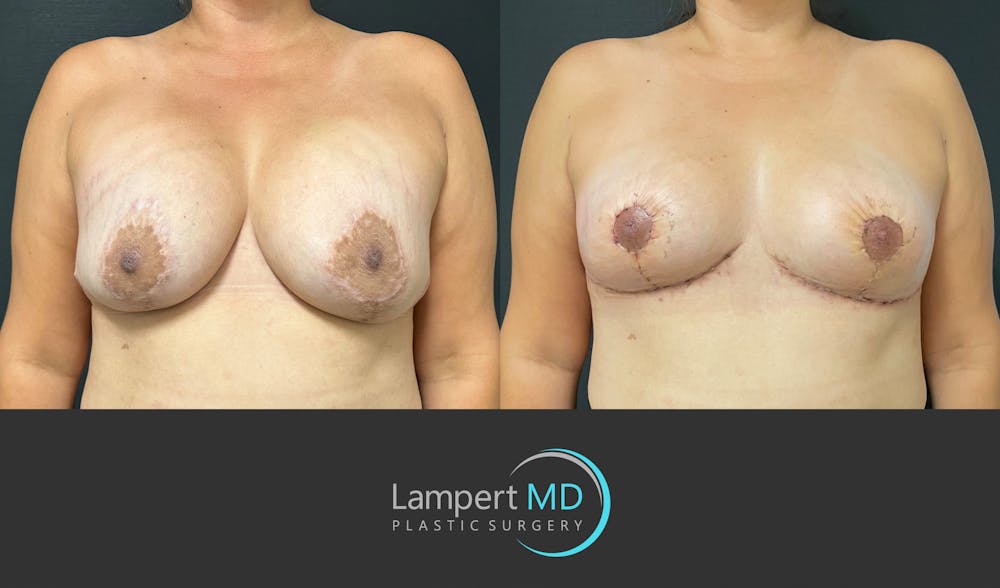 Breast Explant Before & After Gallery - Patient 382083 - Image 1