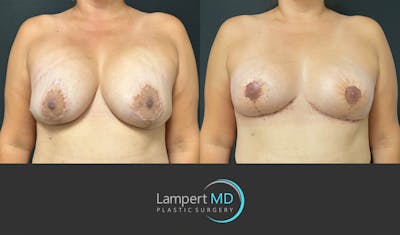 Breast Explant Before & After Gallery - Patient 382083 - Image 1