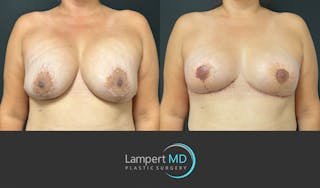 Breast Explant Before & After Gallery - Patient 382083 - Image 1