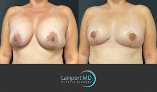 Breast Explant Before & After Gallery - Patient 382083 - Image 2